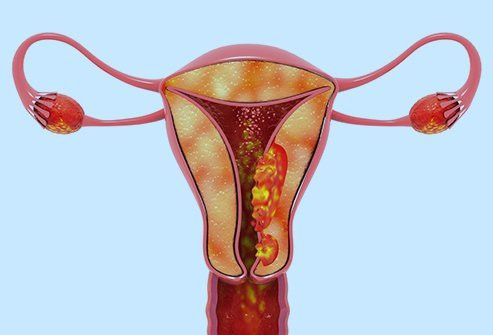 यि महिलालाई हुन्छ पाठेघरको मुखको क्यान्सरको धेरै जोखिम ?
